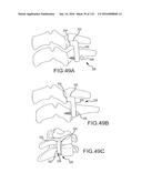 FACET JOINT IMPLANTS AND DELIVERY TOOLS diagram and image