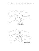 FACET JOINT IMPLANTS AND DELIVERY TOOLS diagram and image