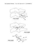 FACET JOINT IMPLANTS AND DELIVERY TOOLS diagram and image