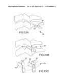 FACET JOINT IMPLANTS AND DELIVERY TOOLS diagram and image