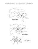 FACET JOINT IMPLANTS AND DELIVERY TOOLS diagram and image