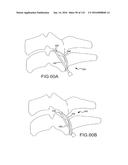 FACET JOINT IMPLANTS AND DELIVERY TOOLS diagram and image