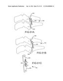 FACET JOINT IMPLANTS AND DELIVERY TOOLS diagram and image