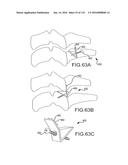 FACET JOINT IMPLANTS AND DELIVERY TOOLS diagram and image