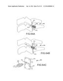 FACET JOINT IMPLANTS AND DELIVERY TOOLS diagram and image