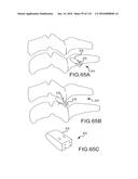 FACET JOINT IMPLANTS AND DELIVERY TOOLS diagram and image