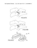 FACET JOINT IMPLANTS AND DELIVERY TOOLS diagram and image