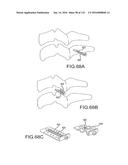 FACET JOINT IMPLANTS AND DELIVERY TOOLS diagram and image