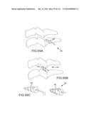 FACET JOINT IMPLANTS AND DELIVERY TOOLS diagram and image