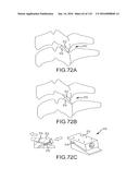 FACET JOINT IMPLANTS AND DELIVERY TOOLS diagram and image