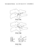 FACET JOINT IMPLANTS AND DELIVERY TOOLS diagram and image