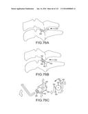 FACET JOINT IMPLANTS AND DELIVERY TOOLS diagram and image