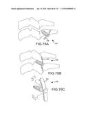 FACET JOINT IMPLANTS AND DELIVERY TOOLS diagram and image