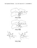 FACET JOINT IMPLANTS AND DELIVERY TOOLS diagram and image