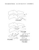 FACET JOINT IMPLANTS AND DELIVERY TOOLS diagram and image