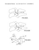 FACET JOINT IMPLANTS AND DELIVERY TOOLS diagram and image