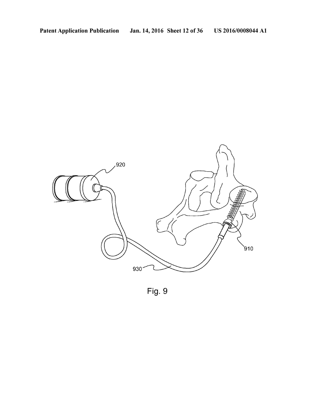 METHOD AND DEVICE FOR DELIVERING MEDICINE TO BONE - diagram, schematic, and image 13