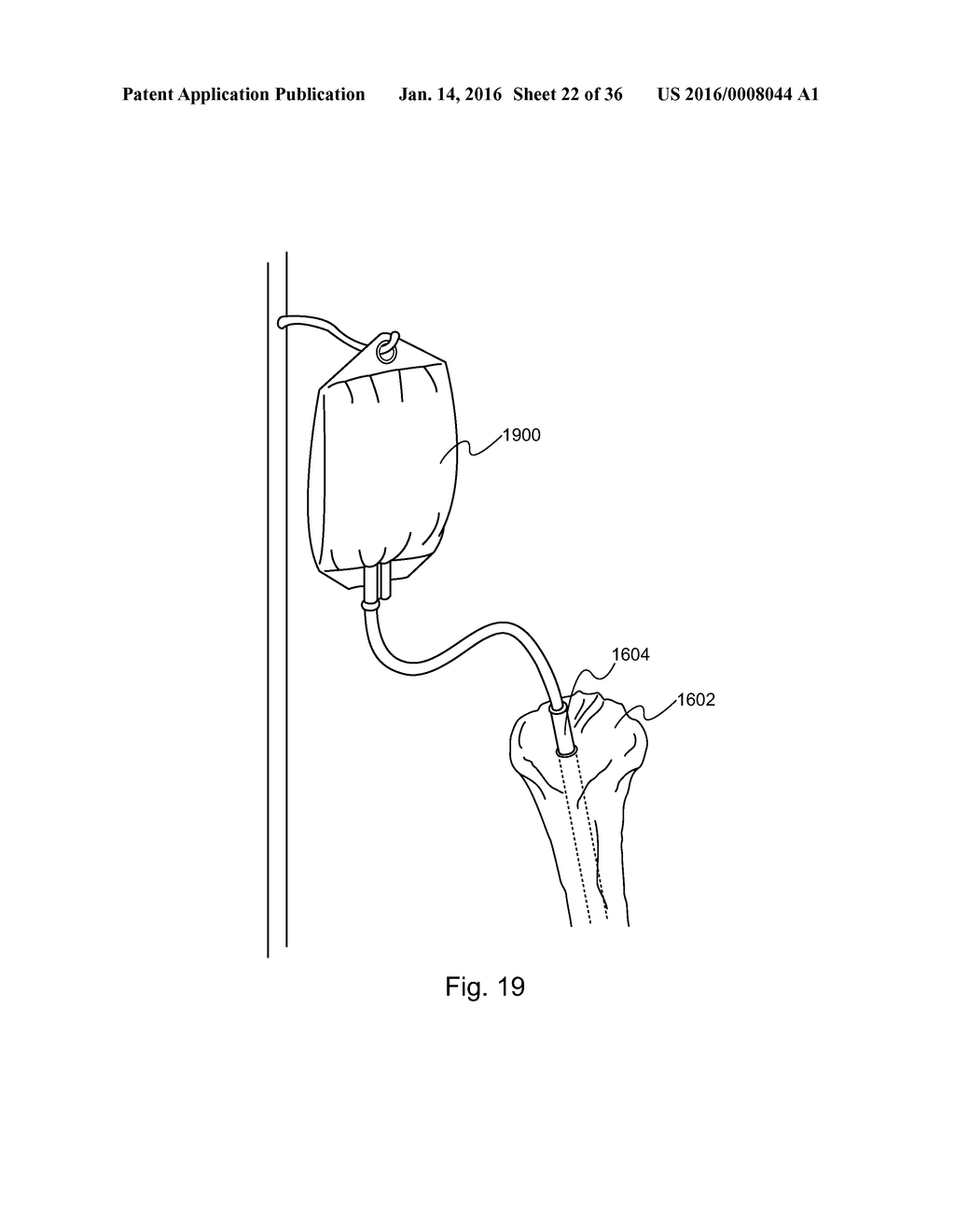 METHOD AND DEVICE FOR DELIVERING MEDICINE TO BONE - diagram, schematic, and image 23