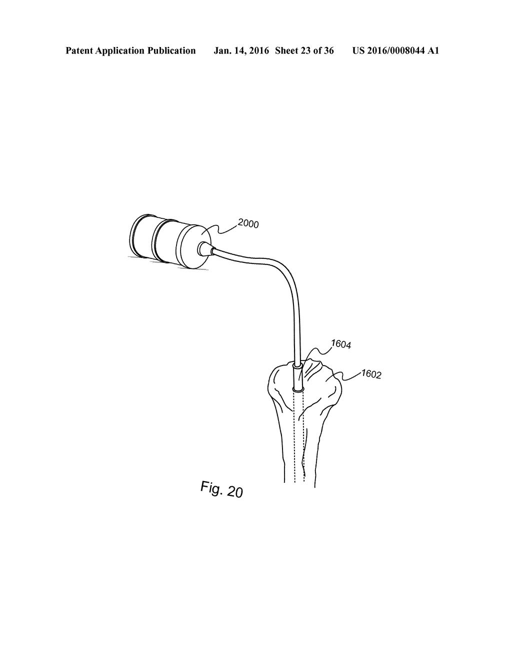 METHOD AND DEVICE FOR DELIVERING MEDICINE TO BONE - diagram, schematic, and image 24