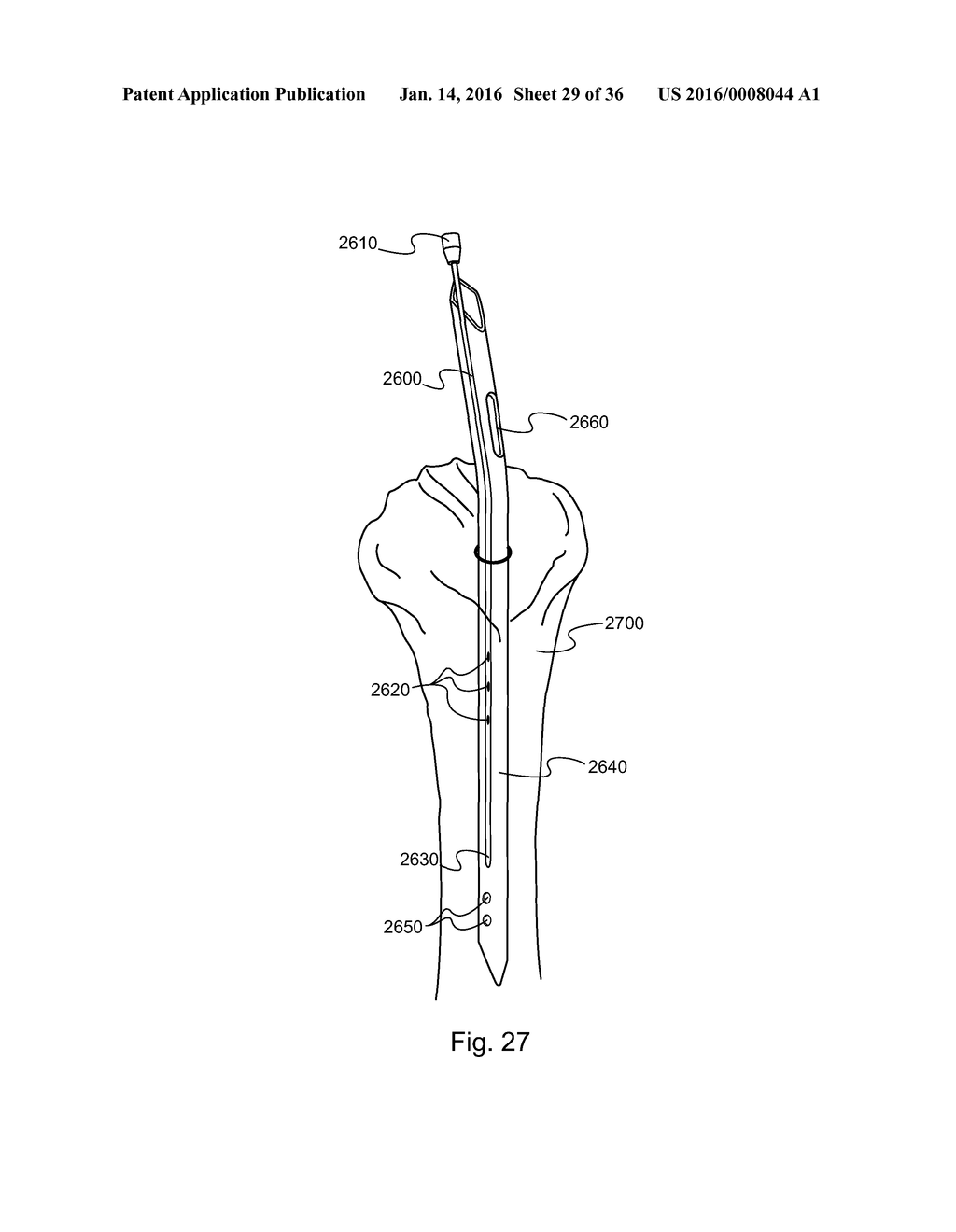 METHOD AND DEVICE FOR DELIVERING MEDICINE TO BONE - diagram, schematic, and image 30