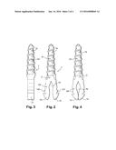 RESORPTIVE INTRAMEDULLARY IMPLANT BETWEEN TWO BONES OR TWO BONE FRAGMENTS diagram and image