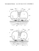 SURGICAL ASSISTING DEVICE diagram and image