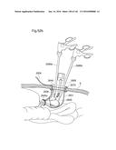 SURGICAL ASSISTING DEVICE diagram and image