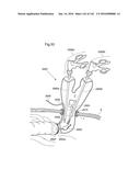 SURGICAL ASSISTING DEVICE diagram and image