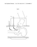 SURGICAL ASSISTING DEVICE diagram and image