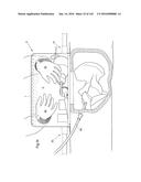 SURGICAL ASSISTING DEVICE diagram and image