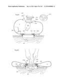 SURGICAL ASSISTING DEVICE diagram and image