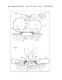 SURGICAL ASSISTING DEVICE diagram and image