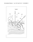 SURGICAL ASSISTING DEVICE diagram and image