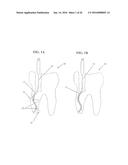 Medical Instrument With Modified Memory and Flexibility Properties and     Method diagram and image