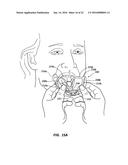 CHEEK AND LIP EXPANSION DEVICE AND METHOD diagram and image