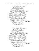 CHEEK AND LIP EXPANSION DEVICE AND METHOD diagram and image