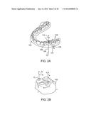 TOOTH MOVEMENT MEASUREMENT BY AUTOMATIC IMPRESSION MATCHING diagram and image