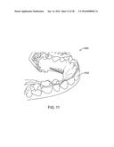 TOOTH MOVEMENT MEASUREMENT BY AUTOMATIC IMPRESSION MATCHING diagram and image