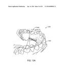 TOOTH MOVEMENT MEASUREMENT BY AUTOMATIC IMPRESSION MATCHING diagram and image