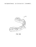 TOOTH MOVEMENT MEASUREMENT BY AUTOMATIC IMPRESSION MATCHING diagram and image