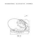 TOOTH MOVEMENT MEASUREMENT BY AUTOMATIC IMPRESSION MATCHING diagram and image