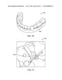 TOOTH MOVEMENT MEASUREMENT BY AUTOMATIC IMPRESSION MATCHING diagram and image