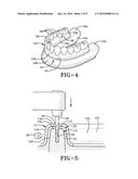 METHOD OF INSTALLING A FINAL DENTAL PROSTHESIS diagram and image