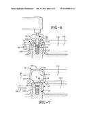 METHOD OF INSTALLING A FINAL DENTAL PROSTHESIS diagram and image