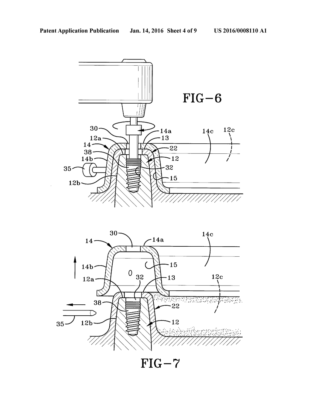 METHOD OF INSTALLING A FINAL DENTAL PROSTHESIS - diagram, schematic, and image 05