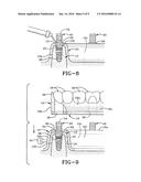 METHOD OF INSTALLING A FINAL DENTAL PROSTHESIS diagram and image