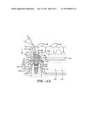 METHOD OF INSTALLING A FINAL DENTAL PROSTHESIS diagram and image