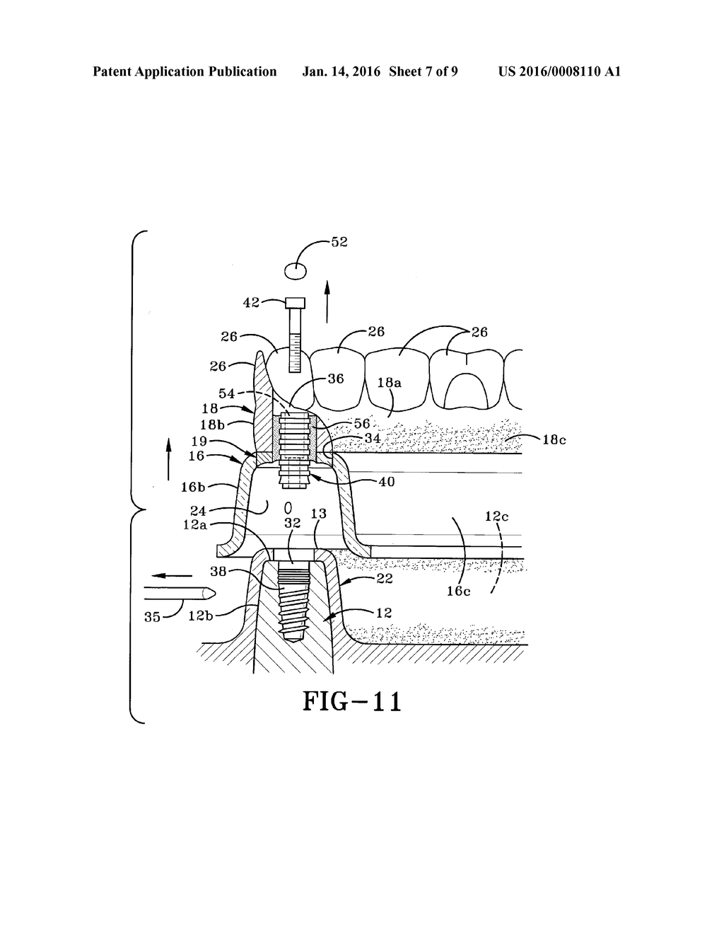 METHOD OF INSTALLING A FINAL DENTAL PROSTHESIS - diagram, schematic, and image 08