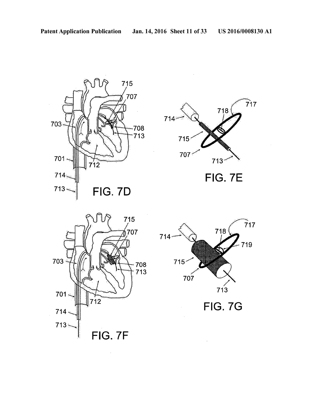 ADJUSTABLE ANNULOPLASTY APPARATUS - diagram, schematic, and image 12