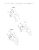 HIP JOINT DEVICE AND METHOD diagram and image